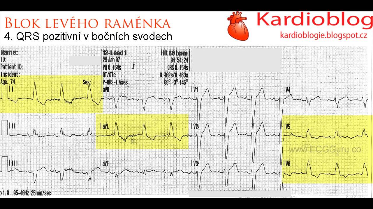 Kardioblog - Blok levého raménka Tawarova
