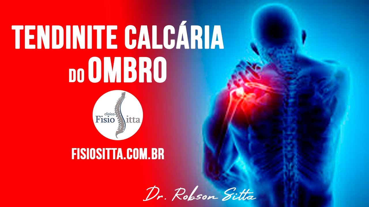 DOR no OMBRO TENDINITE CALCÁRIA CAUSAS e TRATAMENTO de FISIOTERAPIA -  Fisioterapia Dr. Robson Sitta
