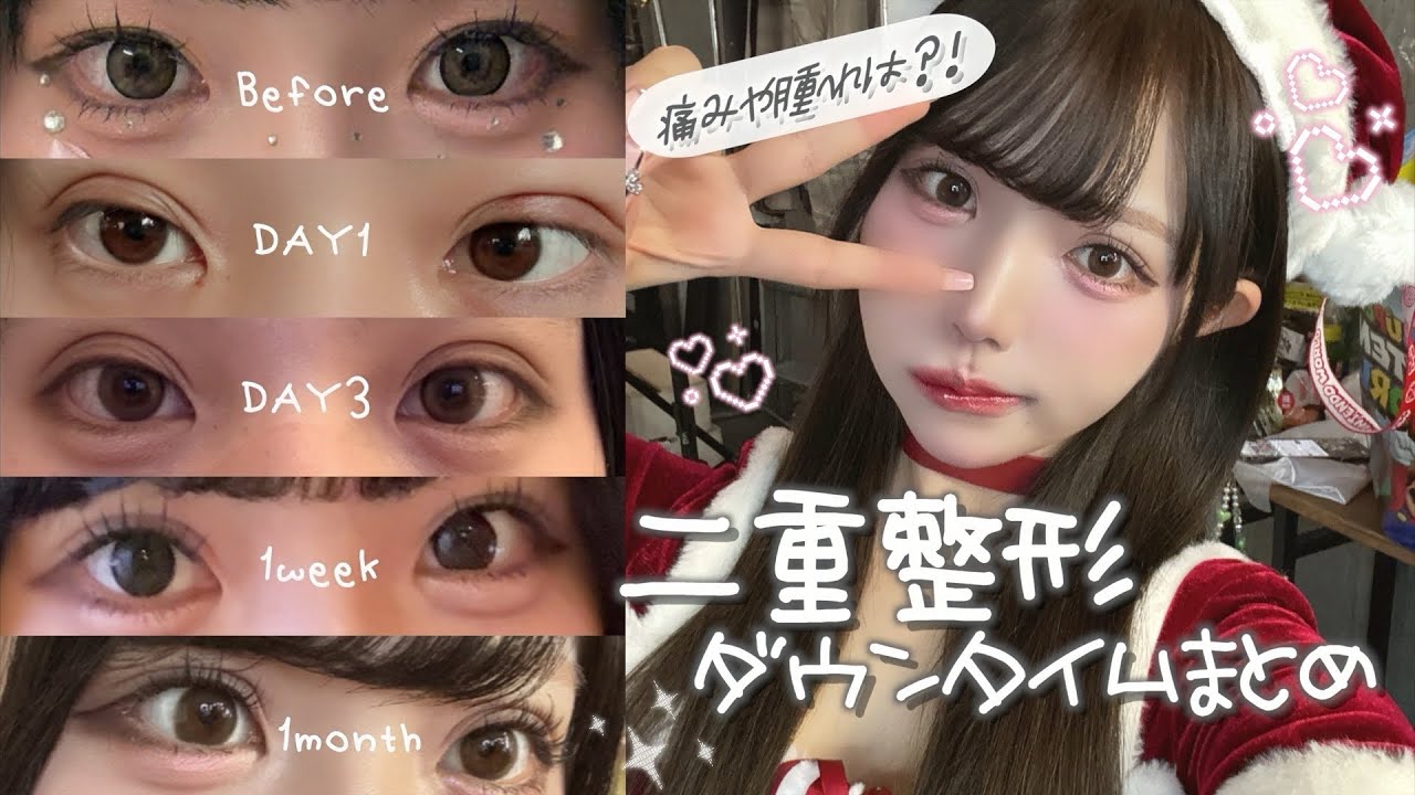 【二重整形】2回目の埋没!!腫れやダウンタイムの様子を正直に話してます🍀*゜
