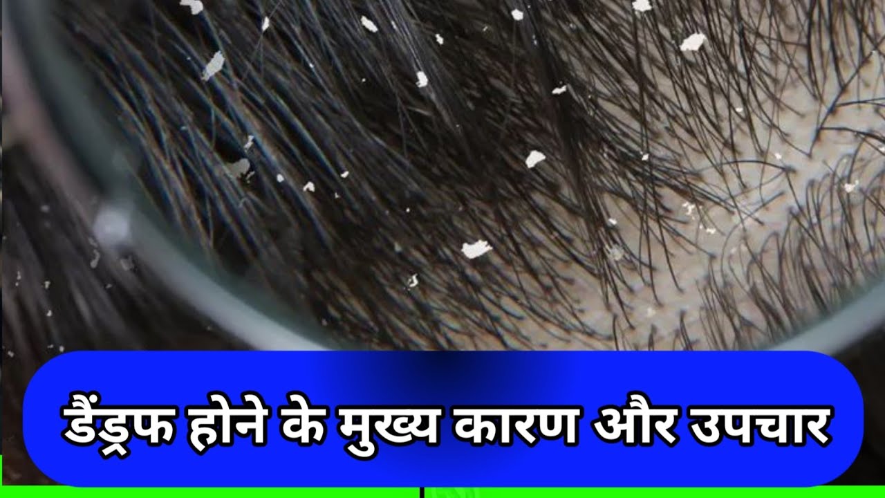 Head Dandruff: Causes & Treatment #shorts #livestream #shortslive #live