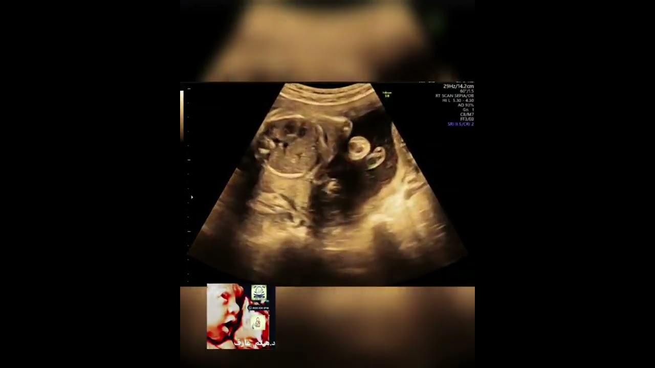 arthrogryposis multiplex congenita fetal ultrasound by Dr.Haissam Aref, DMS, MSc MD ultrasound