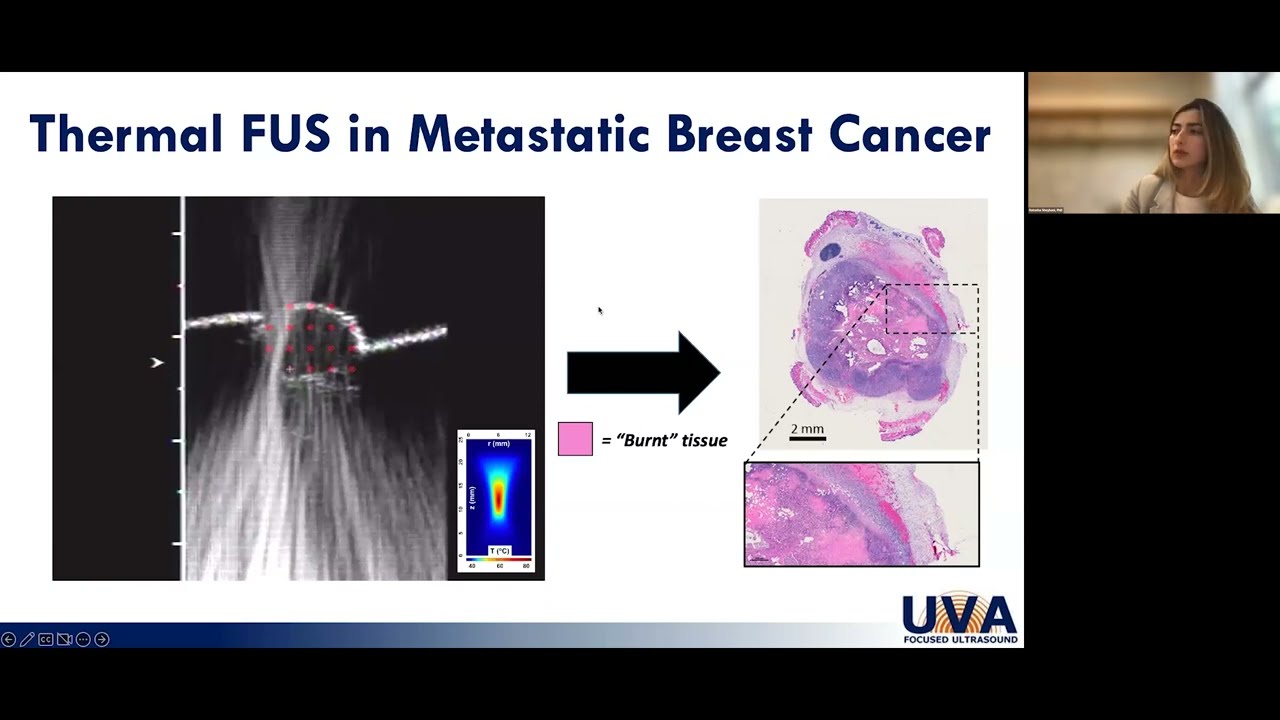 Breast Cancer: Innovative Cancer Treatment and Research at UVA