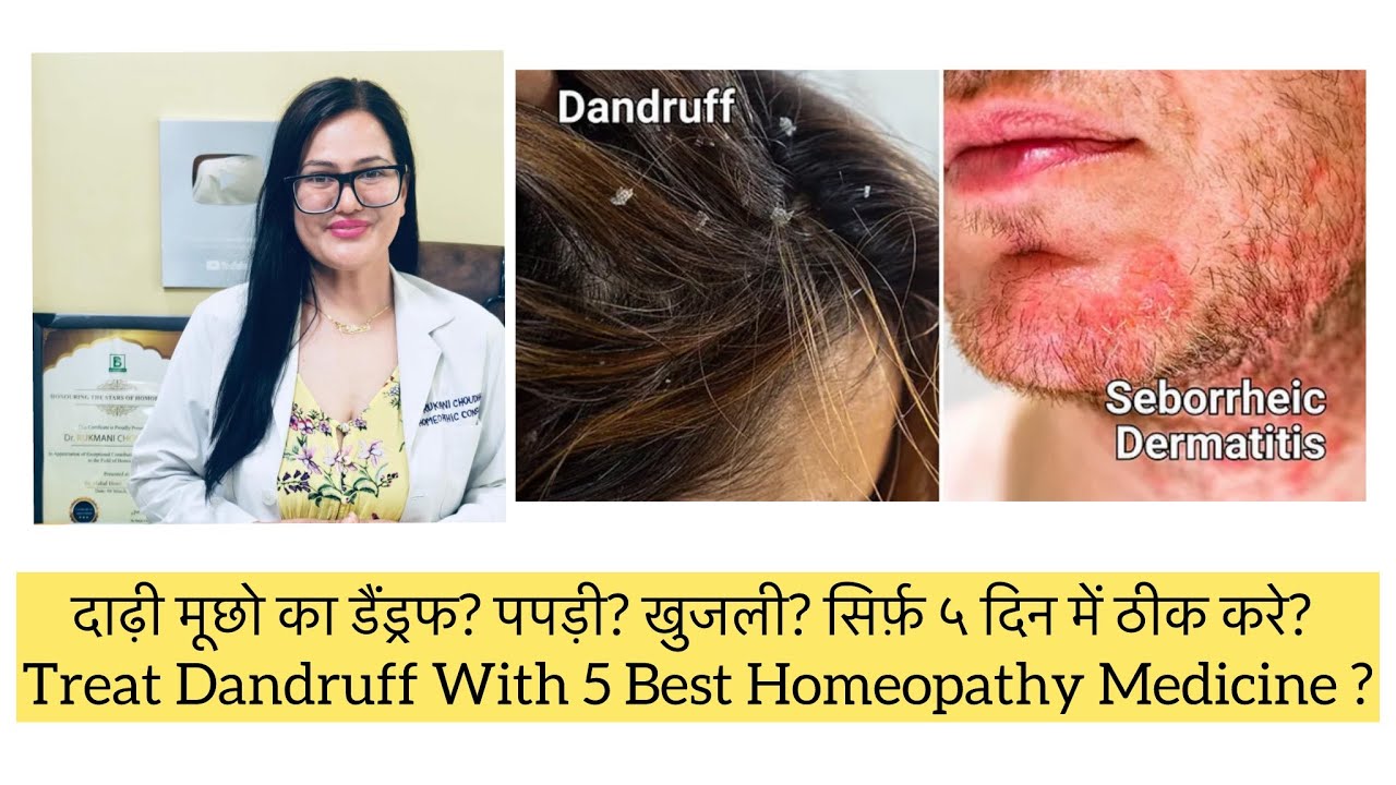 डैंड्रफ? खुजली?पपड़ी?Top5 Proved Homeopathy Medicine In Seborrheic Dermatitis?Seborrhoea?Itchy Scalp