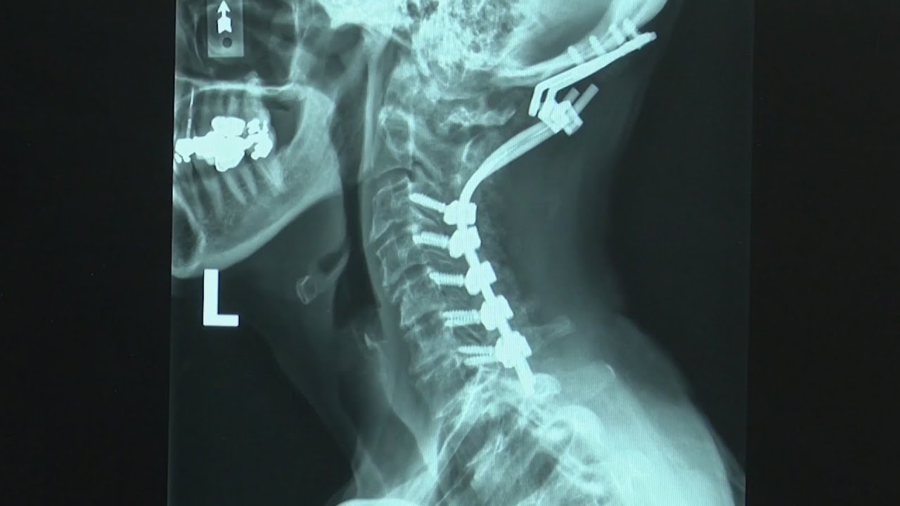 Brighton woman survives 