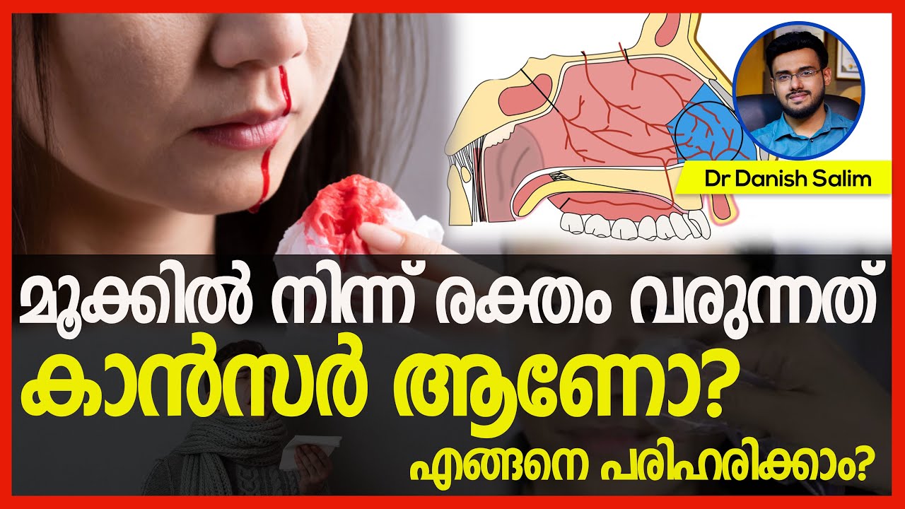 650:👃🏽മൂക്കിൽ നിന്ന് രക്തം വരുന്നത് കാൻസർ ആണോ? എങ്ങനെ പരിഹരിക്കാം? Bleeding from nose..is it cancer?