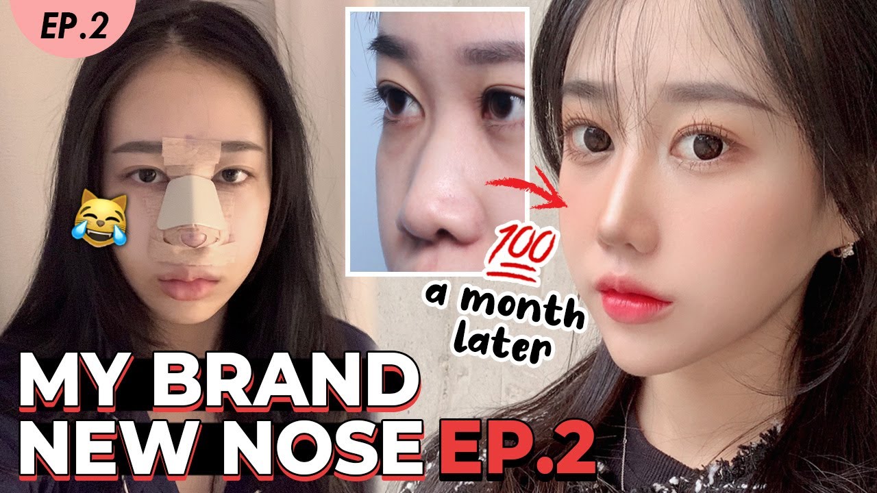 [SUB] Nose Job Review vlog EP. 2 | Check out my results | Rhinoplasty Korea Plastic Surgery Hospital