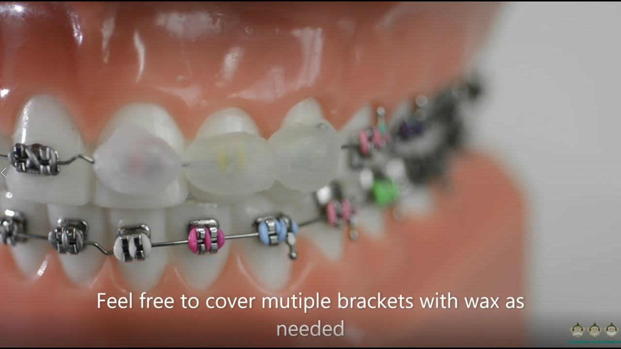 How to use dental wax on braces | Evolution Orthodontics