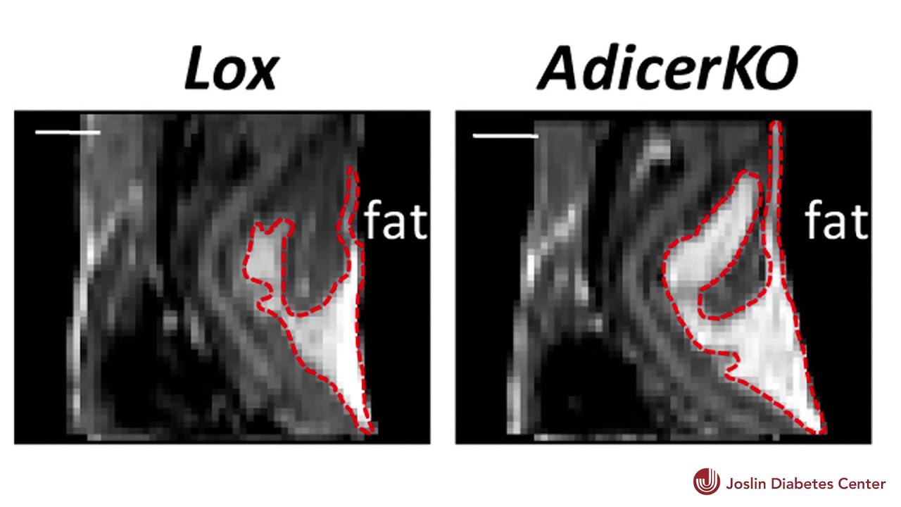 Joslin Scientists Identify Process that Affects Fat Distribution and Metabolic Syndrome