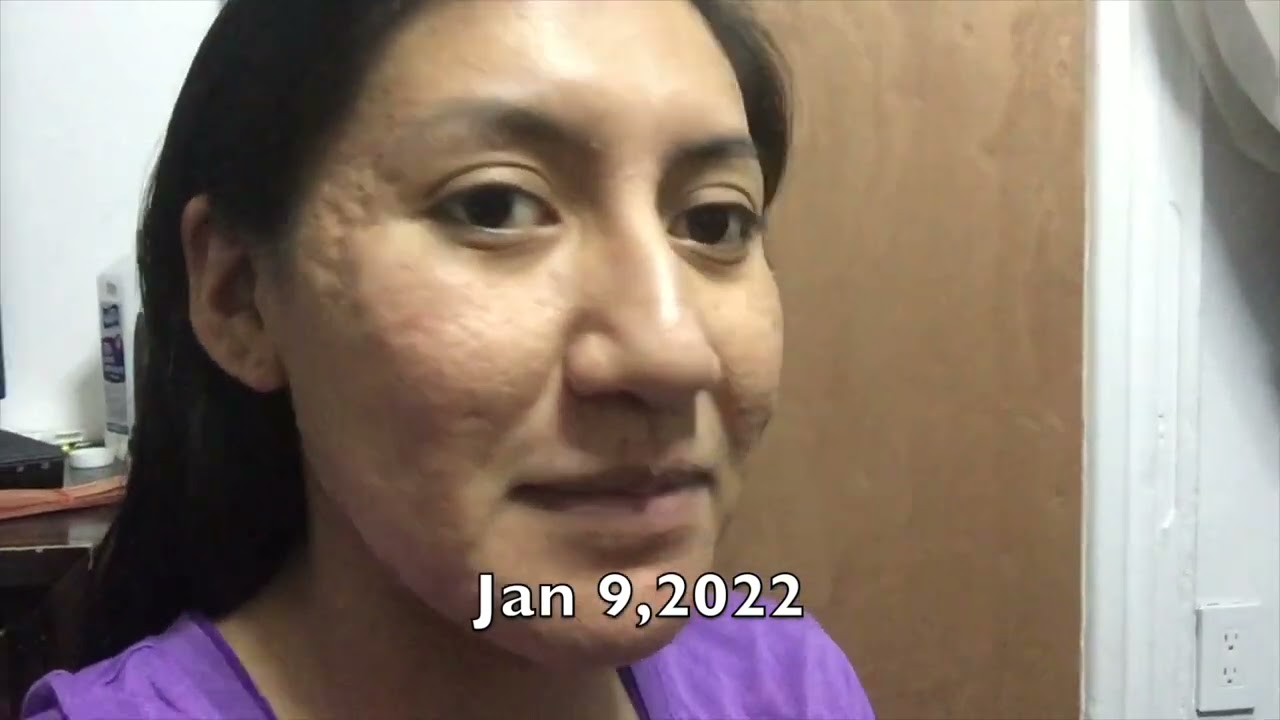 Using the Banish 2.0 for 13 Months