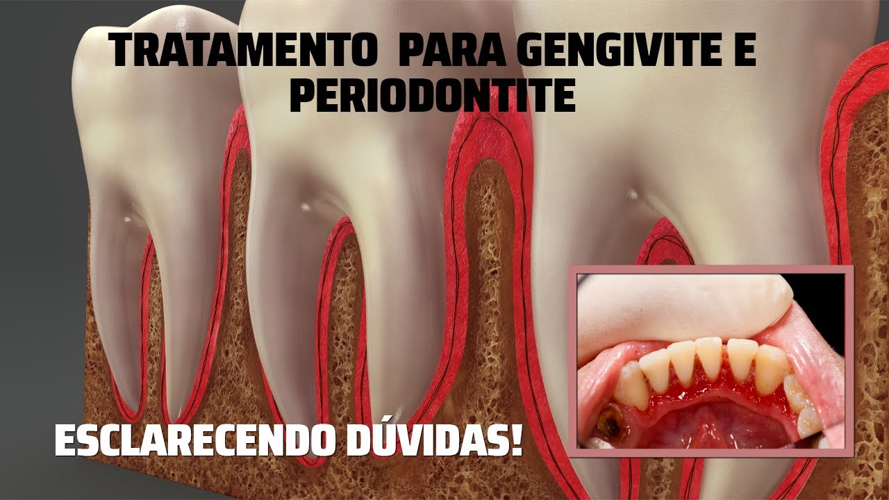 Tratamento para Gengivite e Periodontite - Esclarecendo Dúvidas
