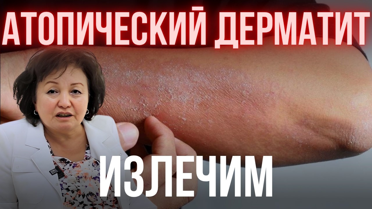 АТОПИЧЕСКИЙ ДЕРМАТИТ - ИЗЛЕЧИМ