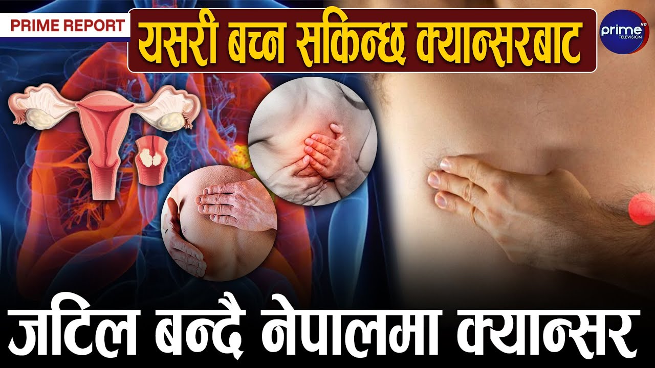 नेपालमा क्यान्सरका अधिकांश बिरामी जटिल चरणमा अस्पताल पुग्ने गरेको निष्कर्ष, नियन्त्रणमा सकस