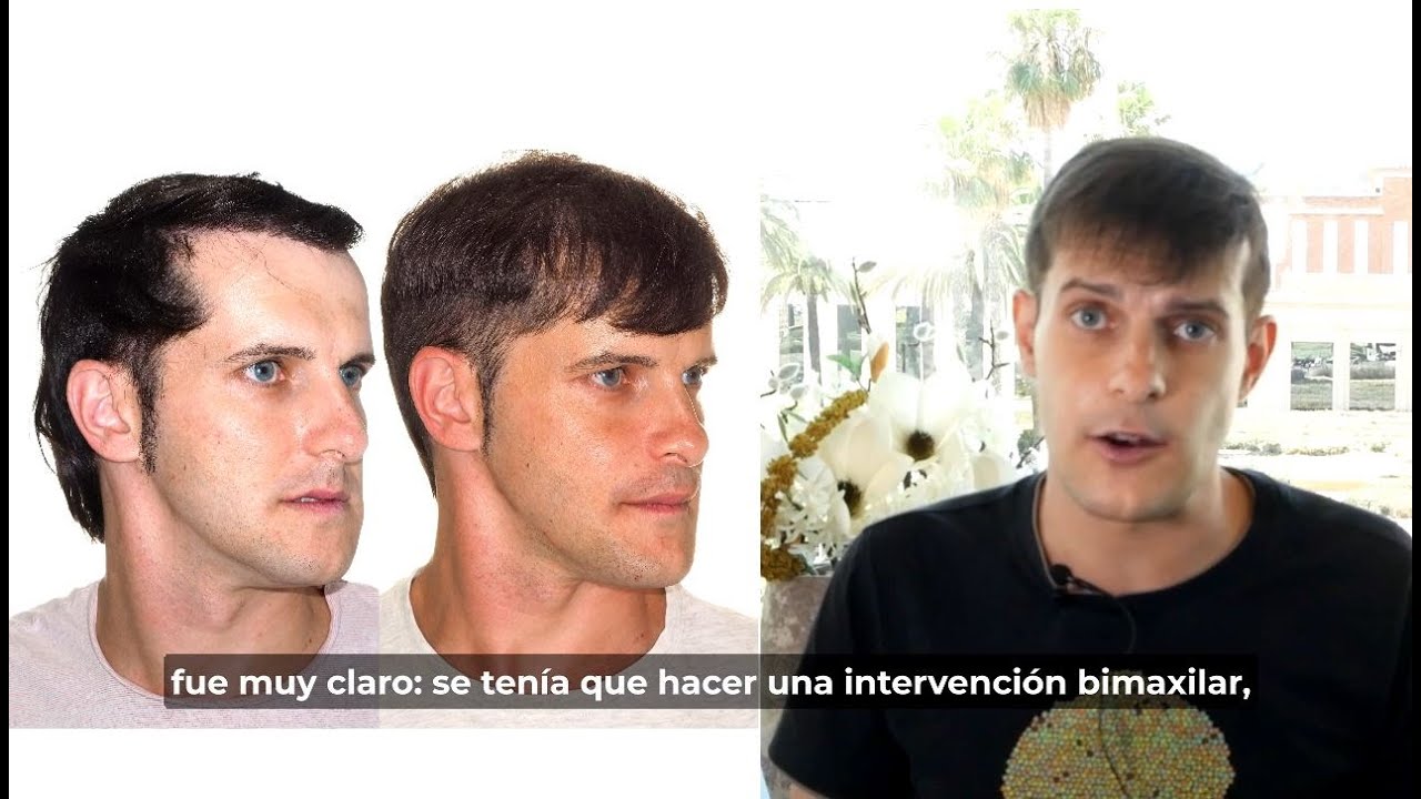 Cirugía bimaxilar Caso #128: David - Clase III, hipoplasia maxilar