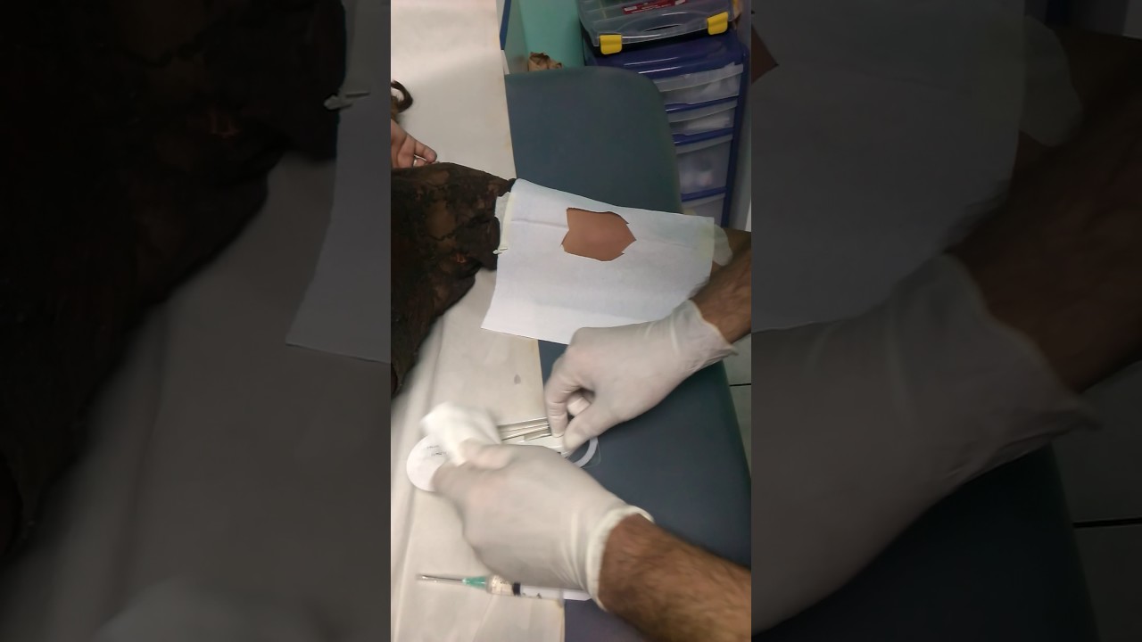 Colocaci&oacute;n de un dispositivo Implanon. Dr. Jos&eacute; Merheb Cortez. Ginec&oacute;logo - Obstetra - Mastologo