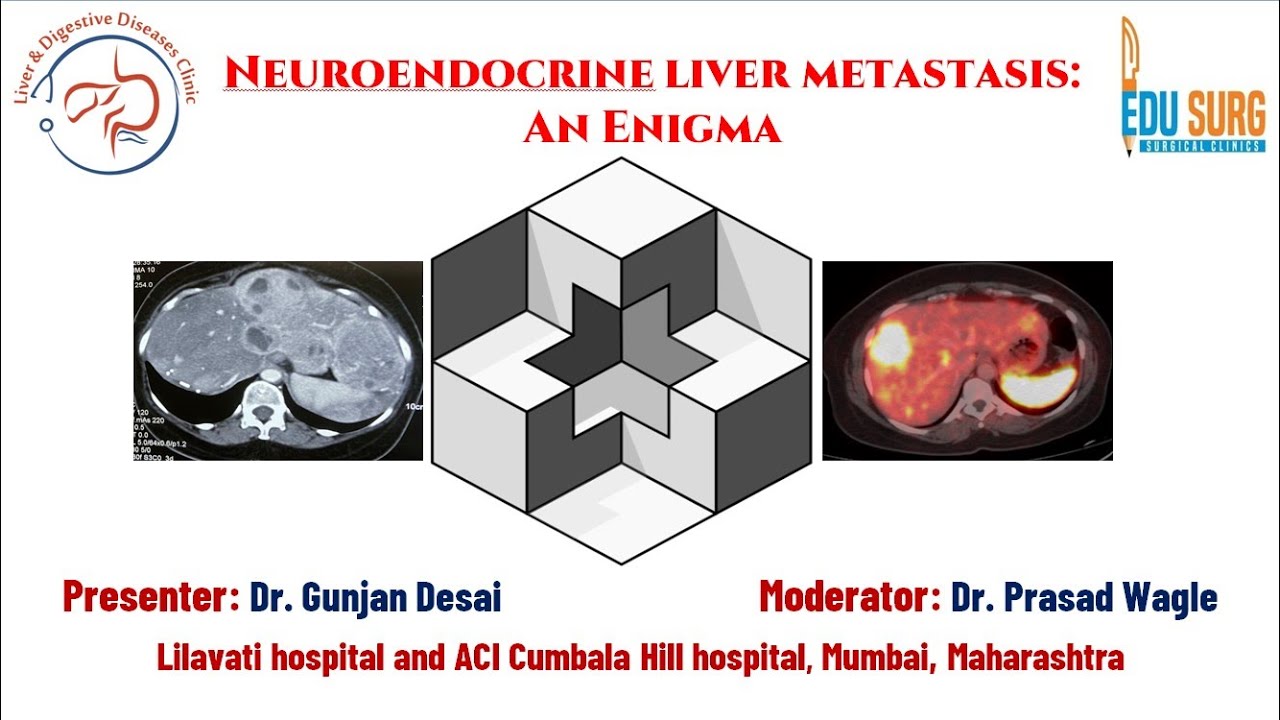 Small intestinal neuroendocrine neoplasm with liver metastasis - A case based discussion