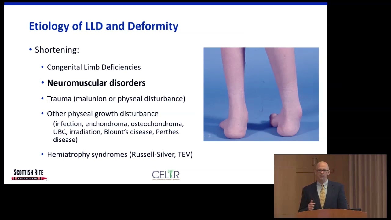 Coffee, Kids and Orthopedics - Limb Length Differences in Children