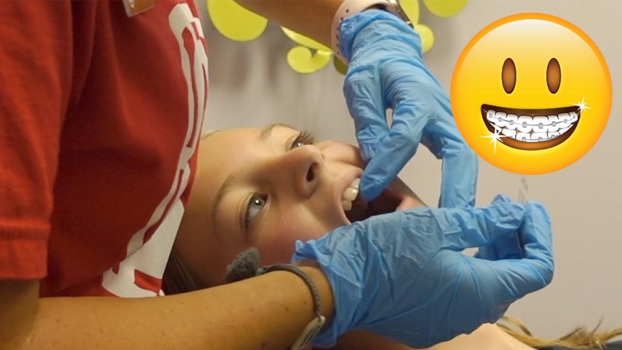ALMOST READY FOR BRACES! | THIS IS HAPPENING SO FAST