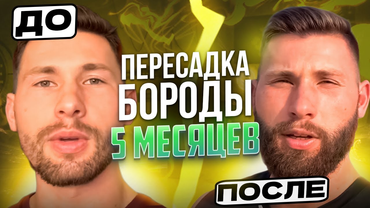 Пересадка бороды / Что стало с бородой через 5 месяцев / Выпуск 19 / Андрей борода