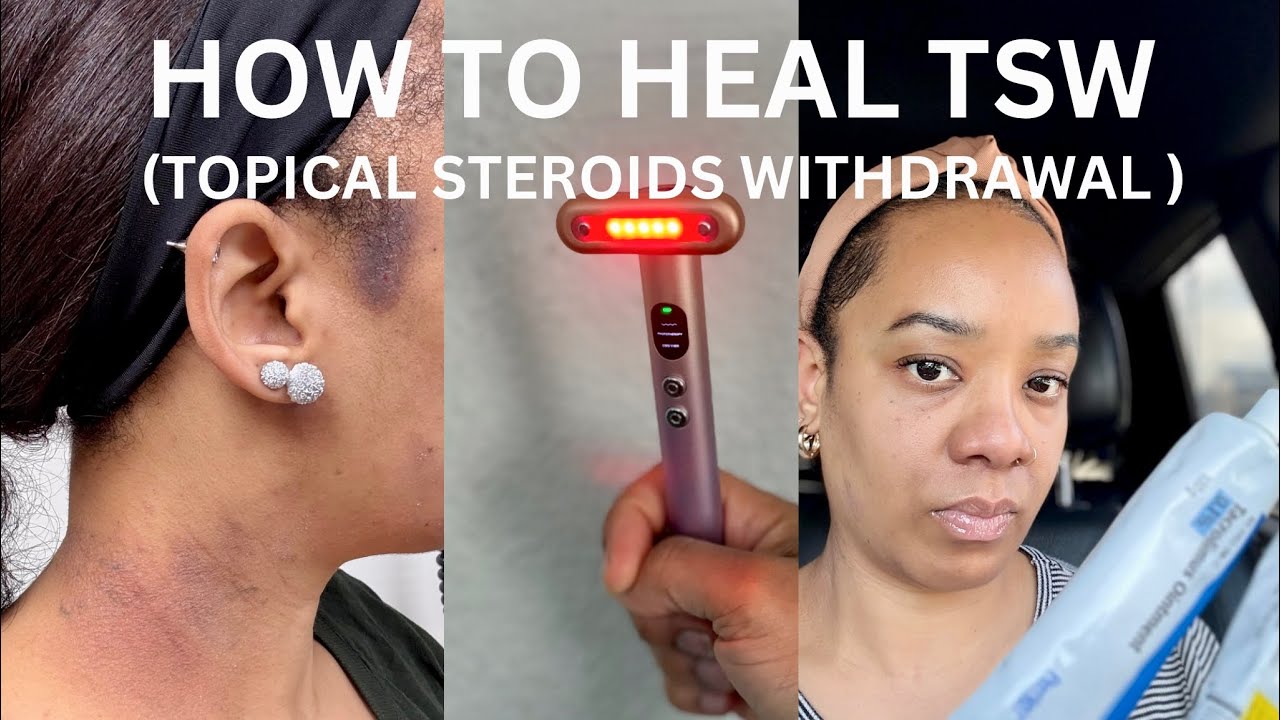 TSW| RED LIGHT THERAPY, NO MOISTURIZER, After Affects.. HOW TO HELP/MANAGE With The Inflammation.