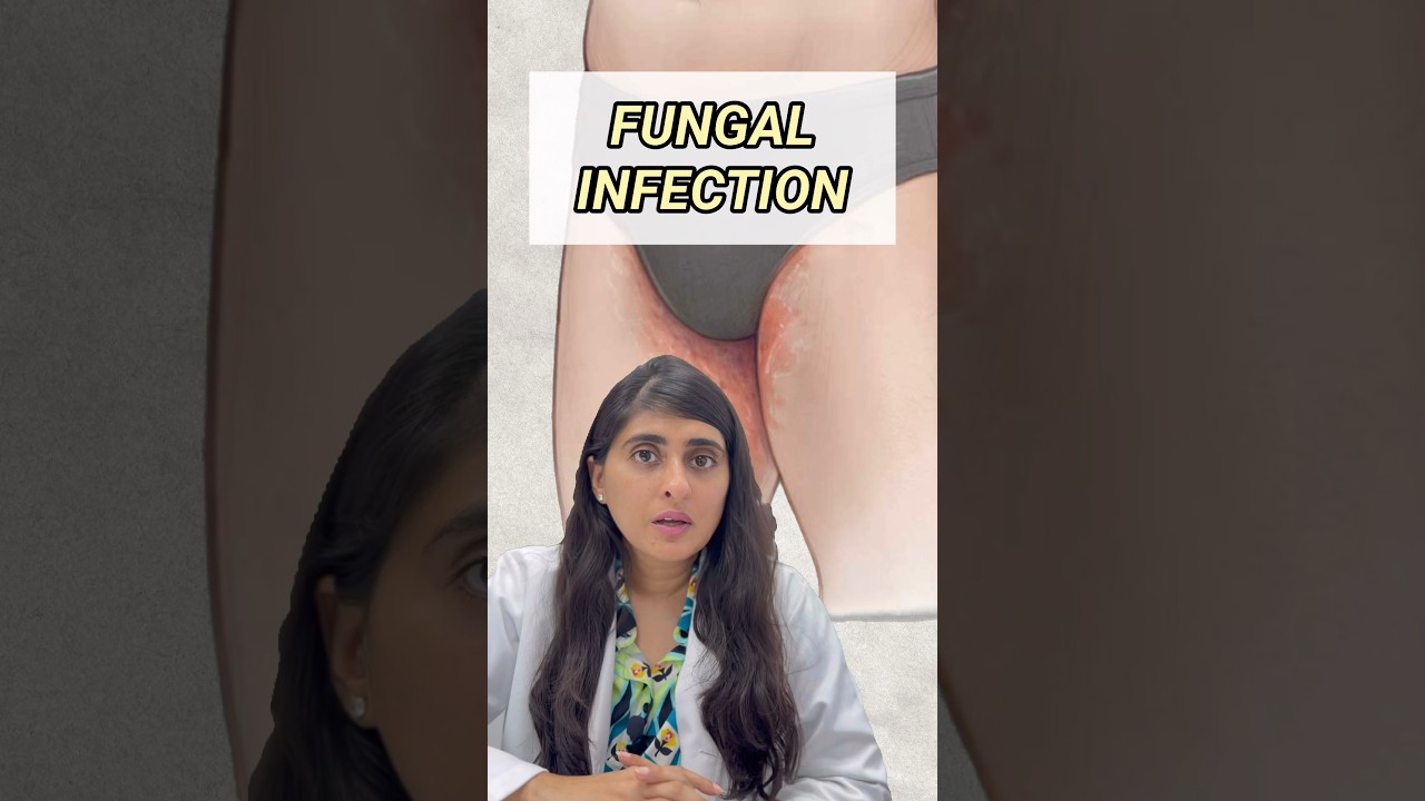 Ringworm?| Ringworm treatment | How to get rid of ringworm| Fungal infection|Don't use home remedies