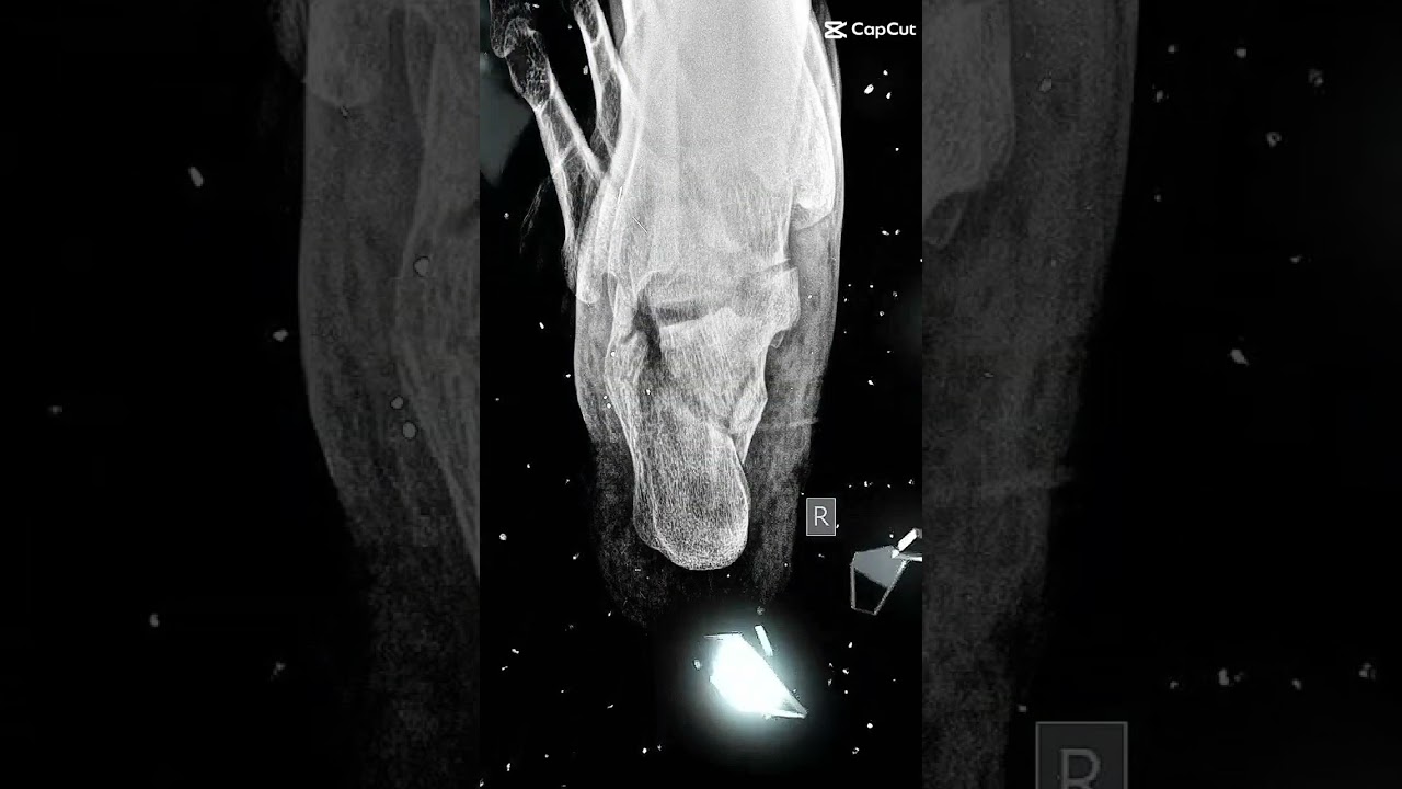 calcaneus fracture 😳#anatomy #dentalxray #hospital @ctscanandmri @123radiology