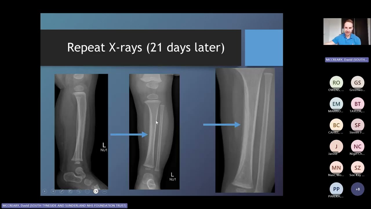 POCUS for acute refusal to weight bear - PEM POCUS UK Feb 2026