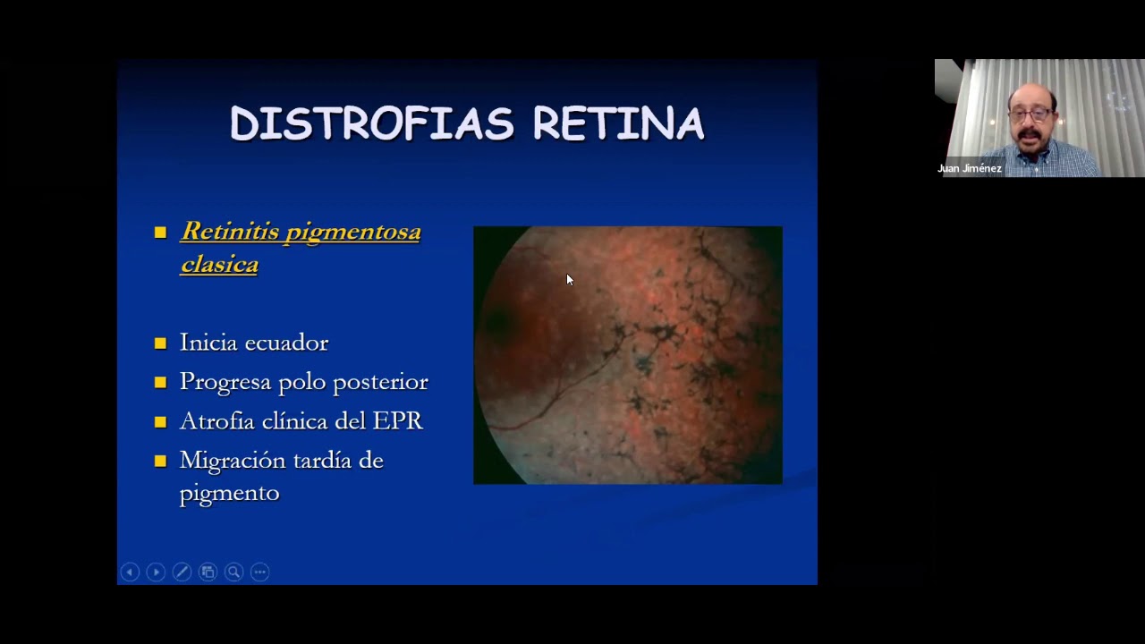 GRAND ROUNDS - APRENDIENDO A RECONOCERLAS DISTROFIAS RETINIANAS