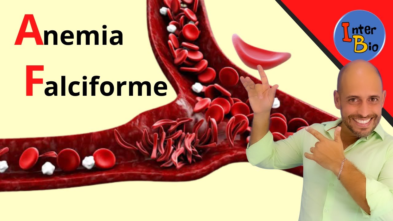 Anemia Falciforme