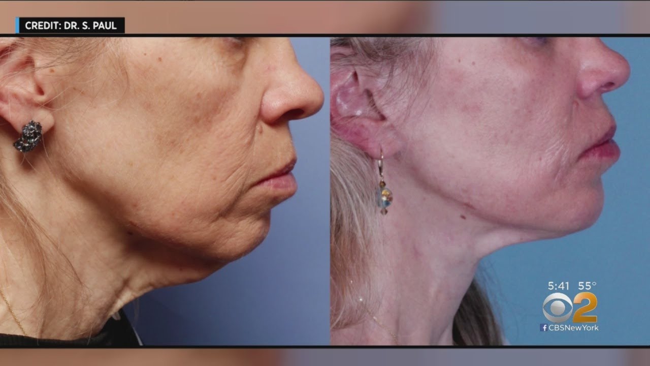Tightening The Skin Without Surgery