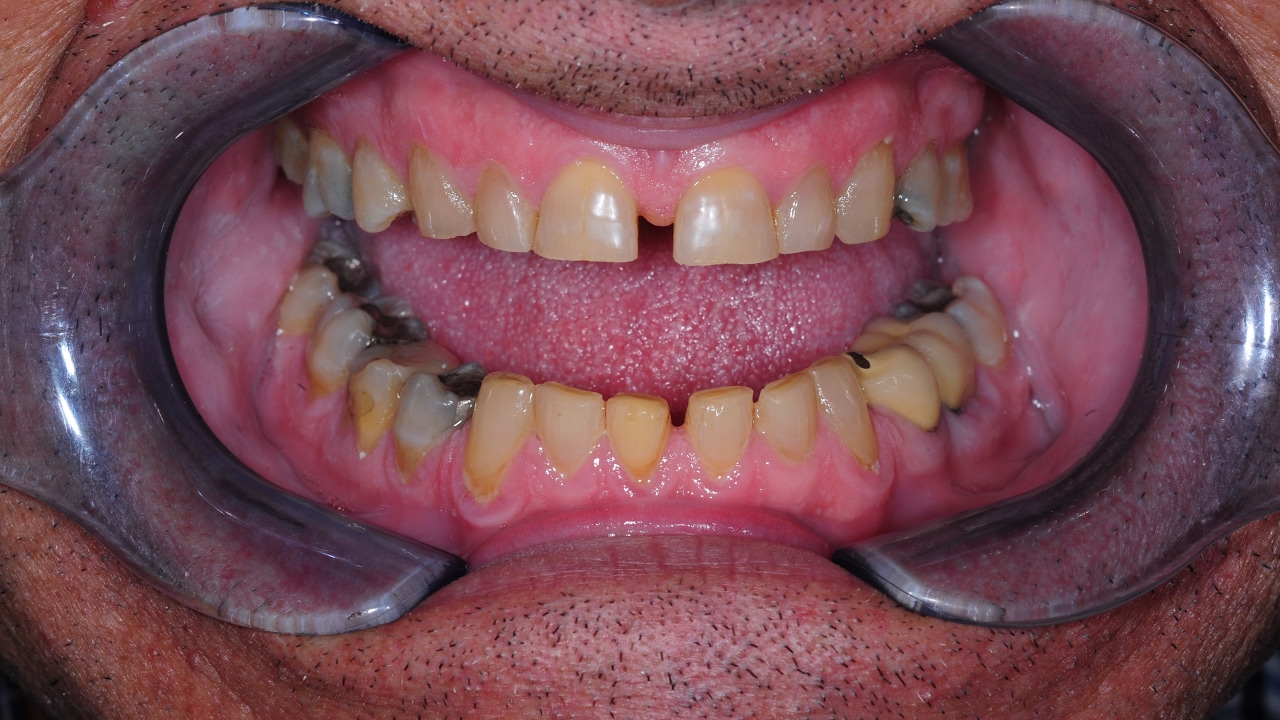 Full Smile Reconstruction with Jack Ringer DDS