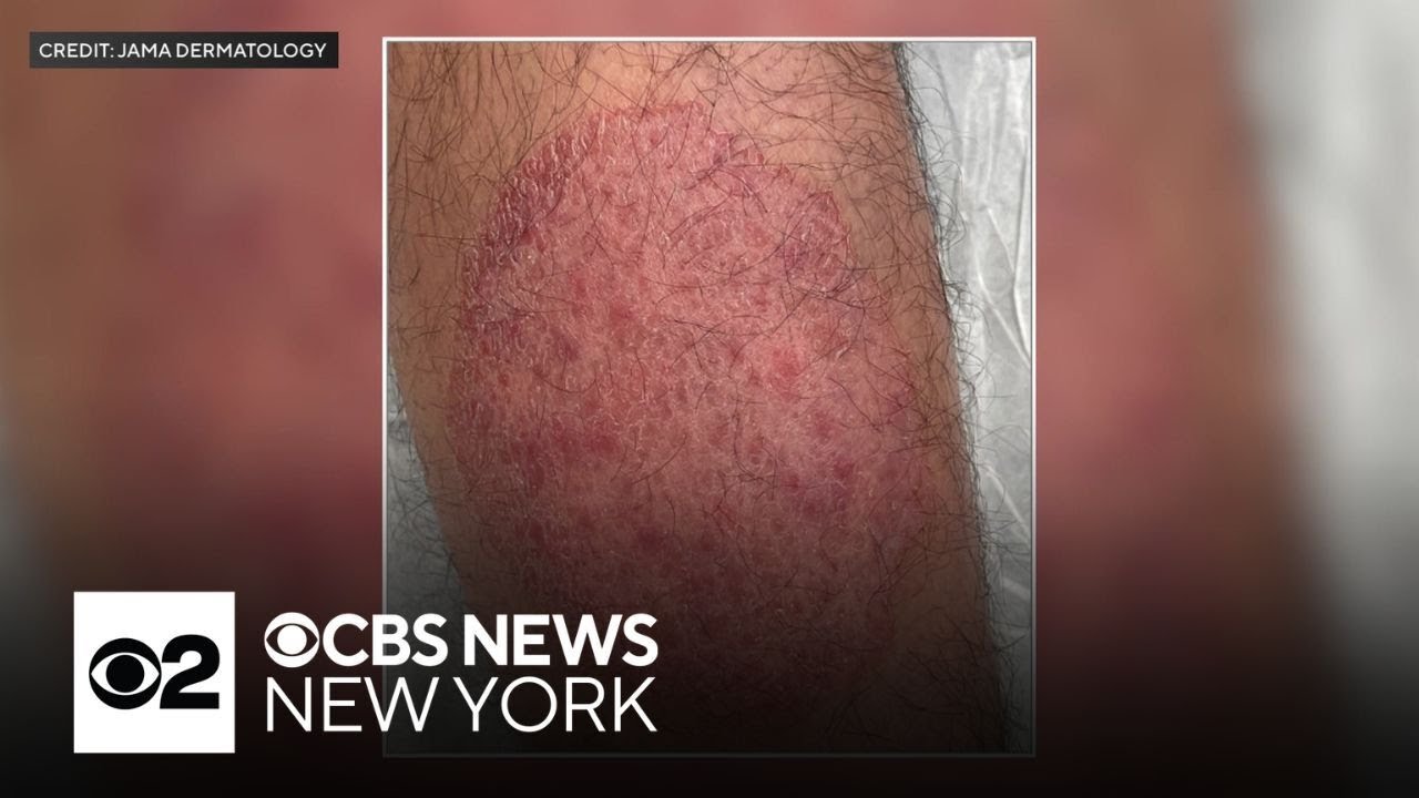 What doctors know about the new sexually transmitted form of ringworm reported in NYC