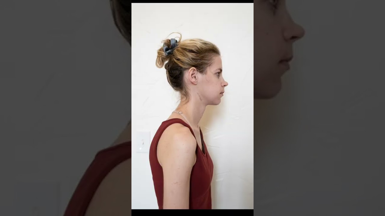 2 weeks post-op from TJR + 1 piece Le Fort + Genioplasty