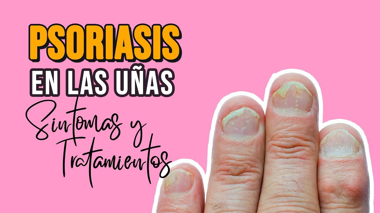 Psoriasis En Las U&ntilde;as, Causas Y Como Tratarla Efectivamente