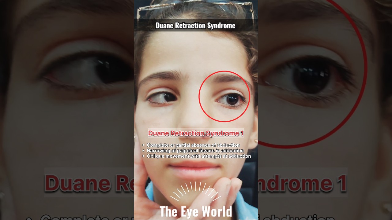 Duane Retraction Syndrome type 1 #strabismus #eyes #ophthalmology