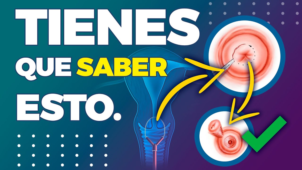 CONIZACIÓN CERVICAL: ¿Por qué se hace? - Ginecología y Obstetricica