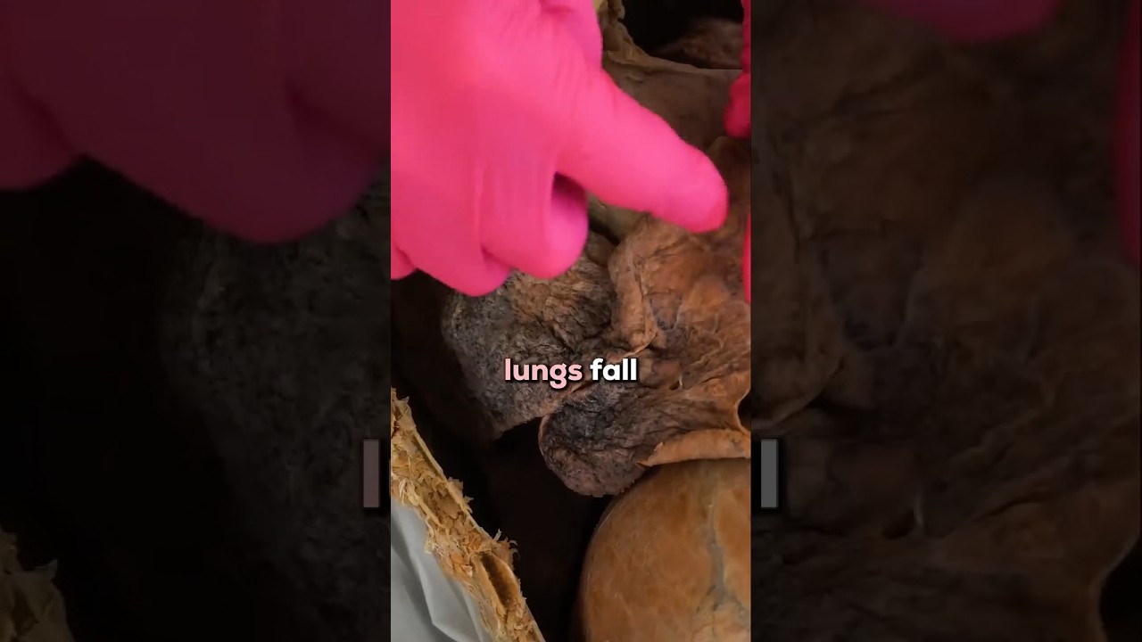 Normal Lungs vs. Smoker's Lungs
