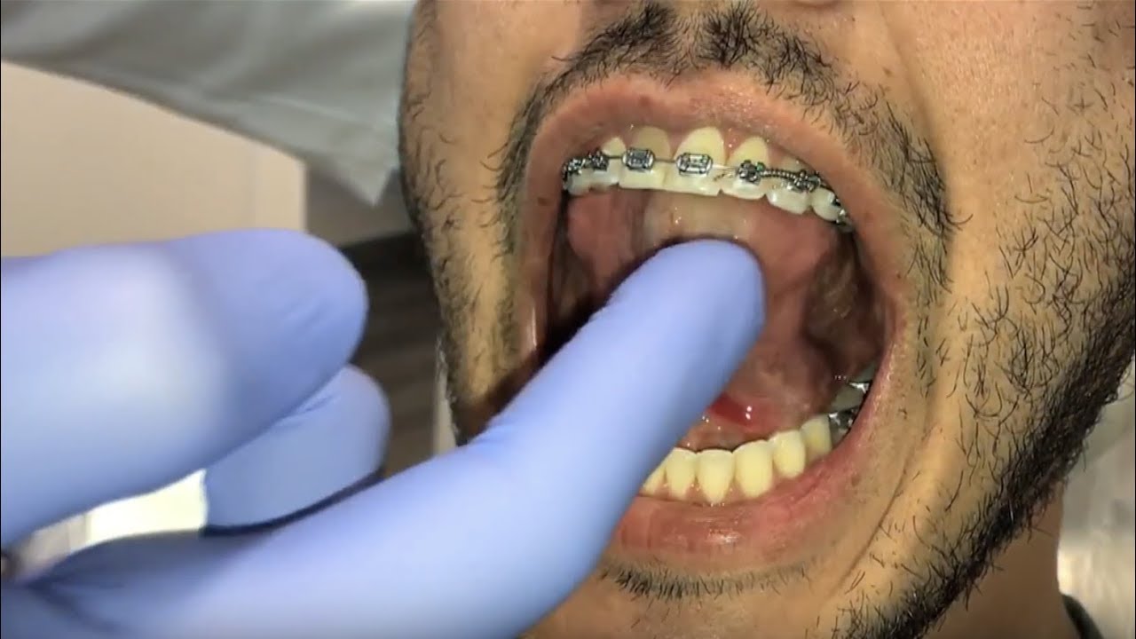 How to do tongue exercises properly after functional frenuloplasty