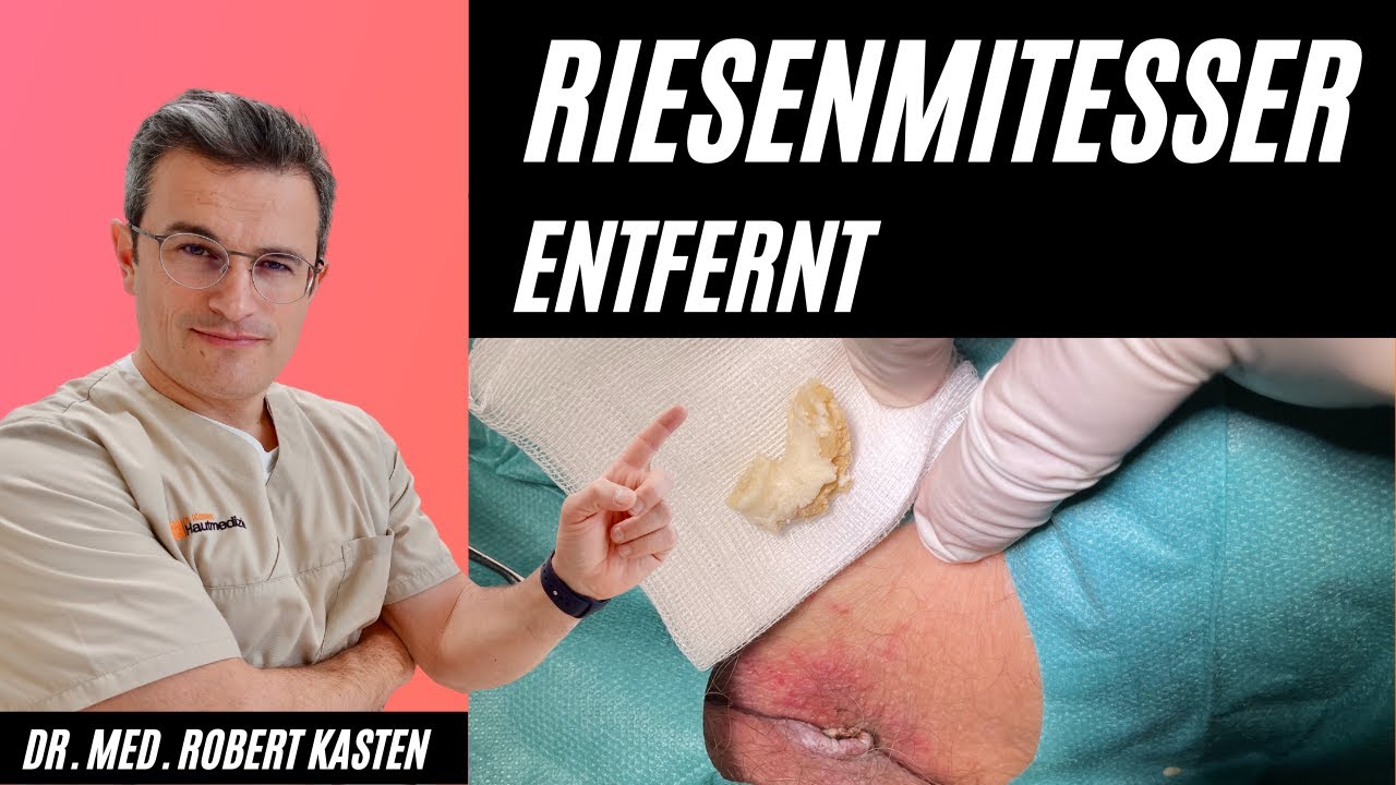 RIESENKOMEDO in der Leiste entfernt: Hautarzt kann es kaum fassen. Mitesser  #pimple giant comedone