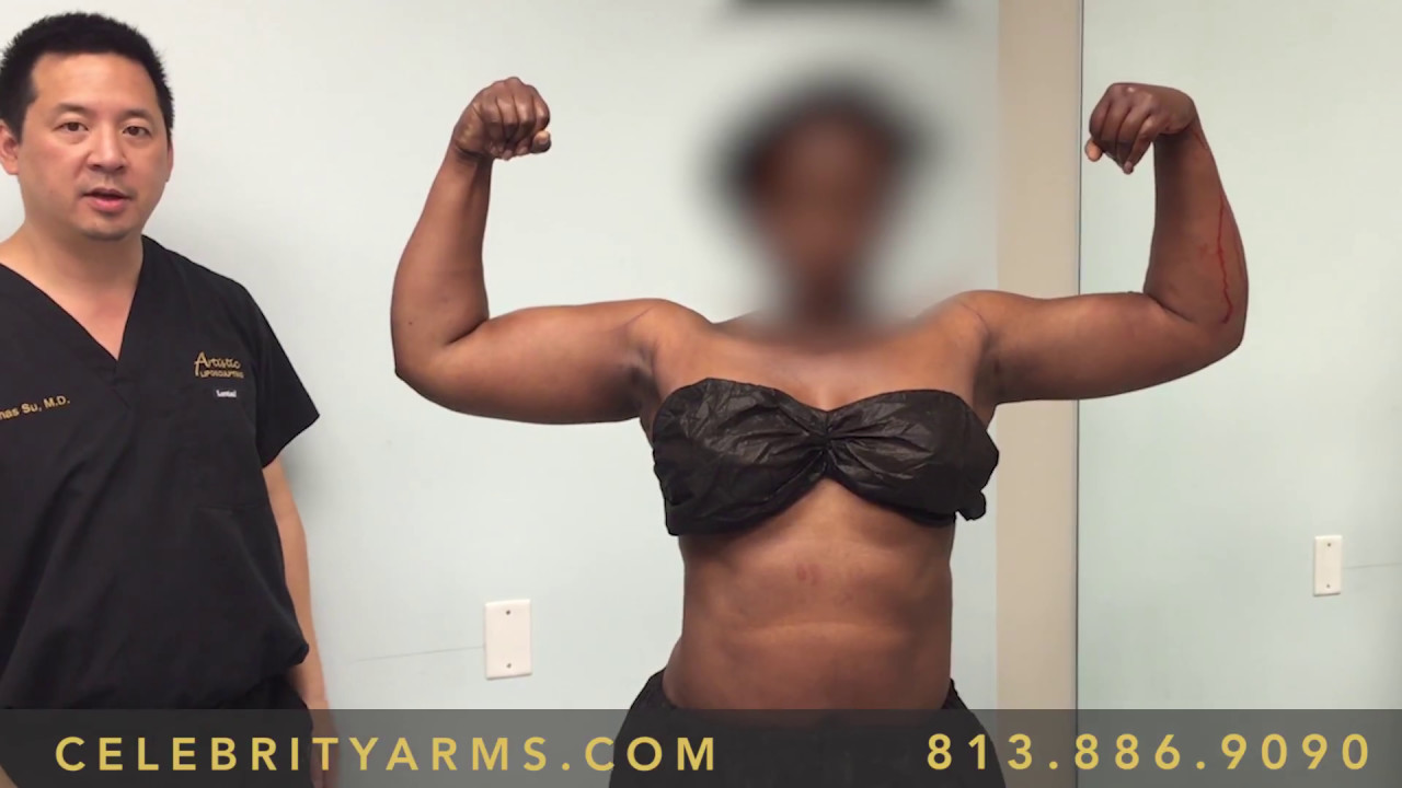 Celebrity Arms&trade; -20 |  High-Definition Ultra-Complete Arm Liposuction | Experts Drs Su and Gruber