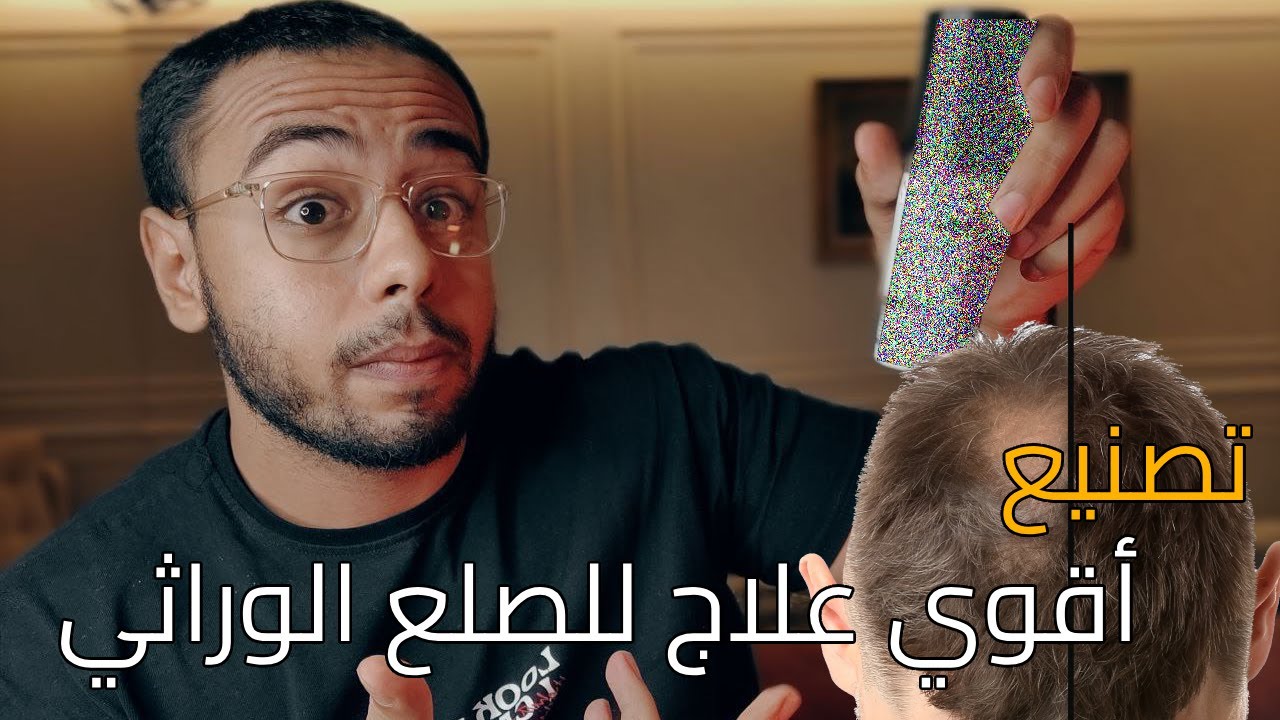 تصنيع أقوي دواء لعلاج الصلع الوراثي كنز مدفون لشركات الأدوية