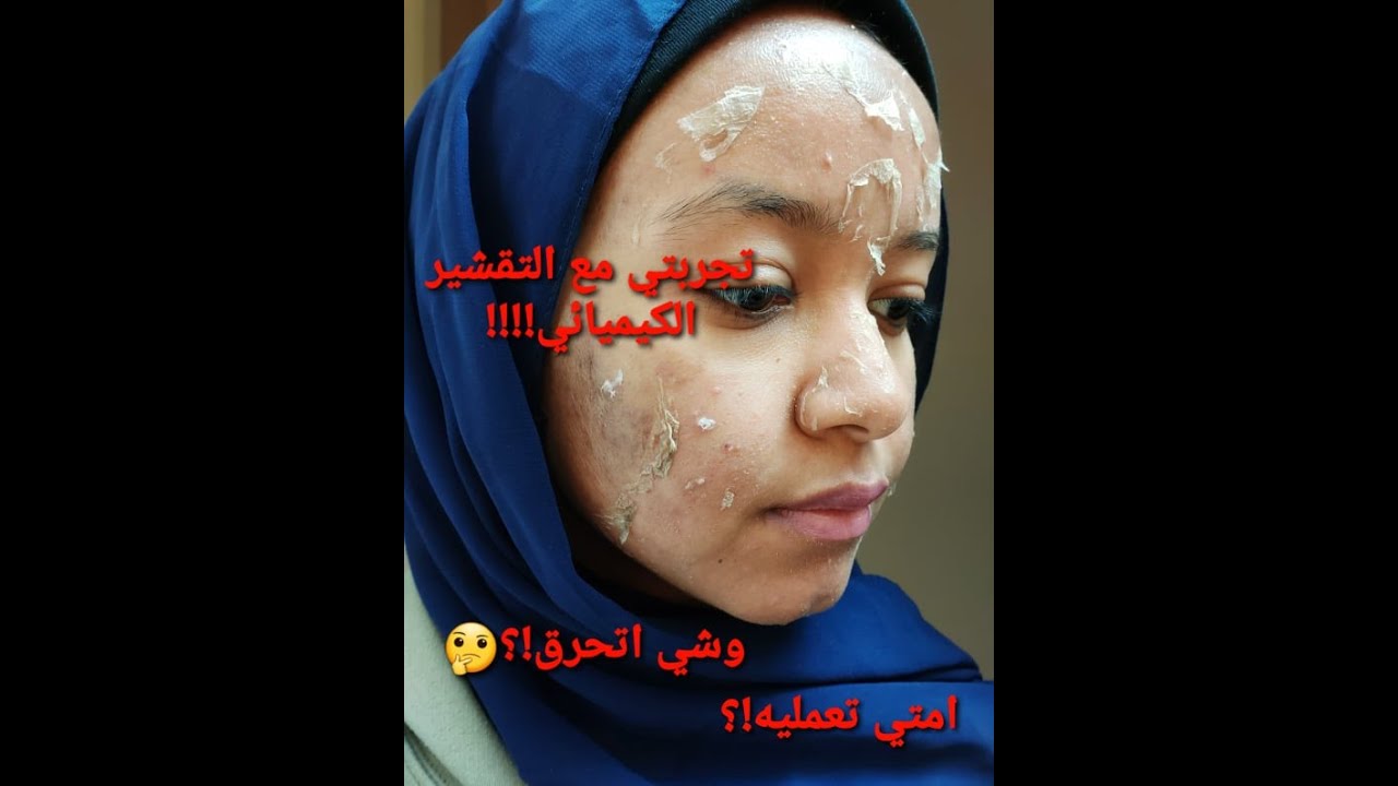 تجربتي مع التقشير الكيميائي!!!!!!