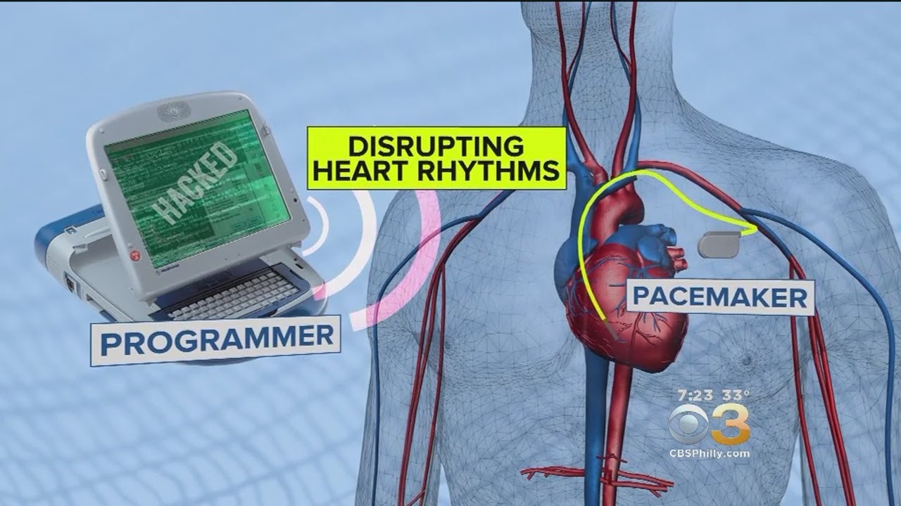 Researchers Say Implanted Medical Devices Vulnerable To Hackers