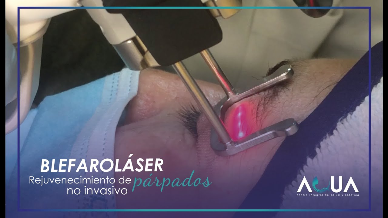 Blefaroláser - Eliminación de exceso de piel en párpados