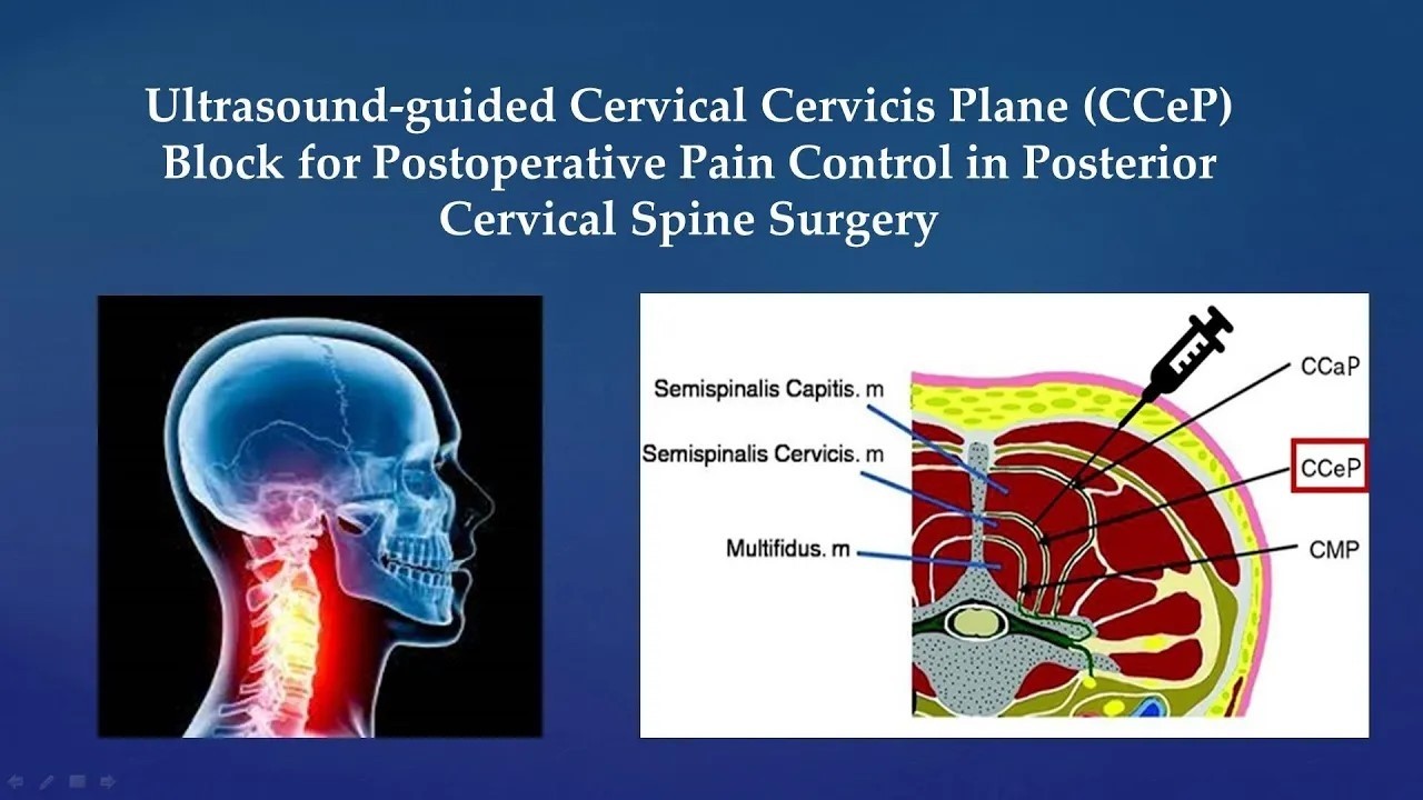 Ultrasound guided cervical cervicis plane (CCeP) block