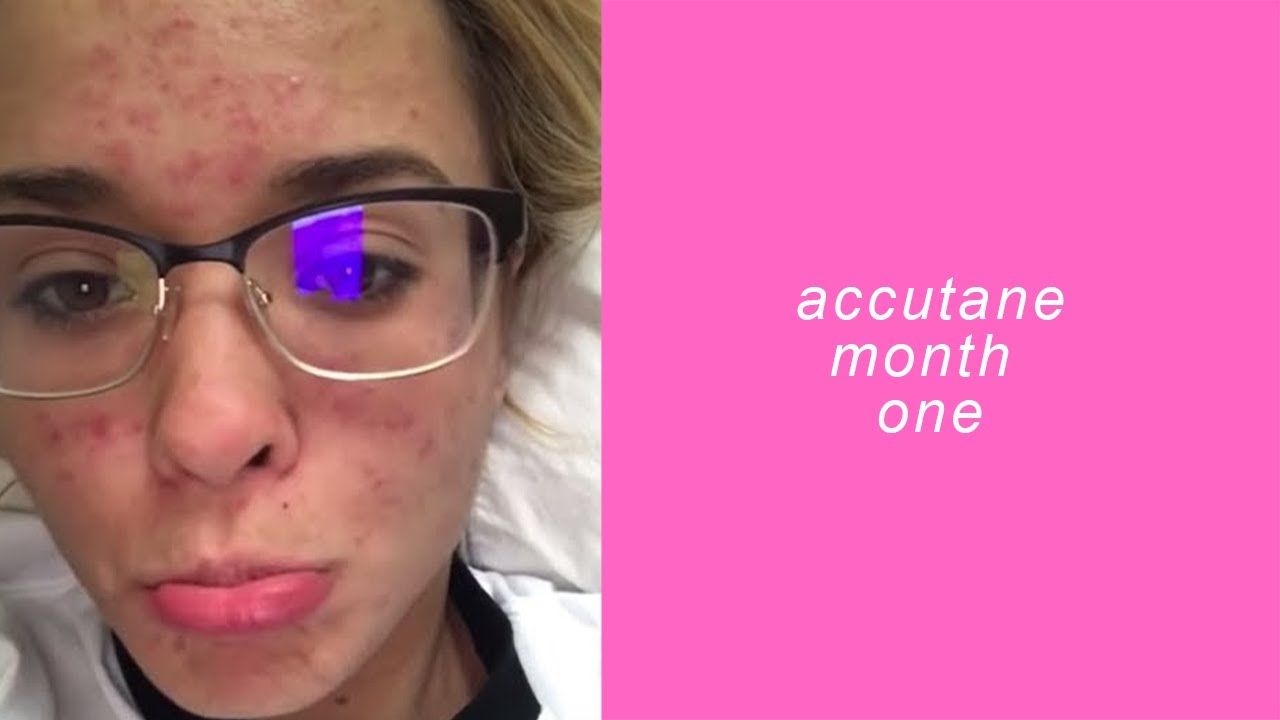 accutane month one | aspenlikeatree