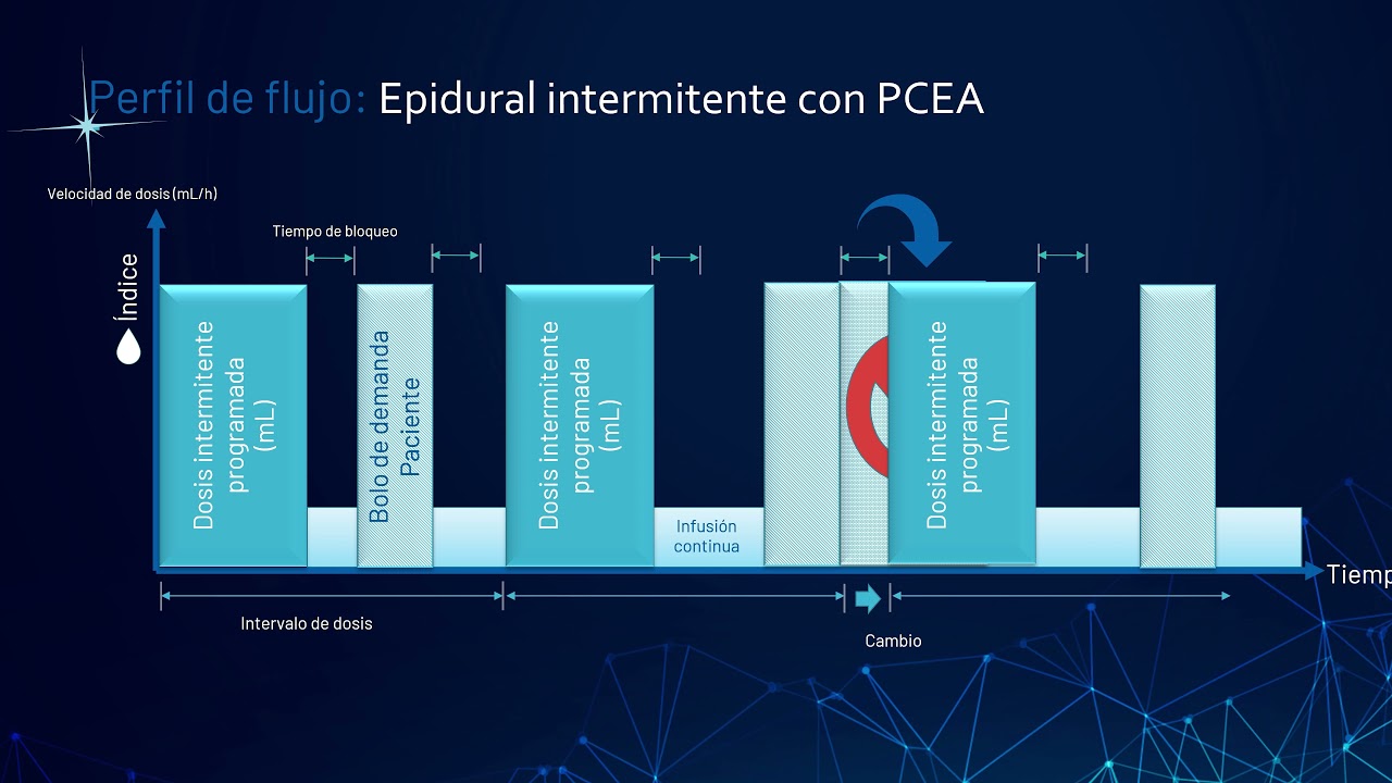 Bombas de Infusión Sapphire - Terapia Epidural PIEB (bolos epidurales intermitentes programados)