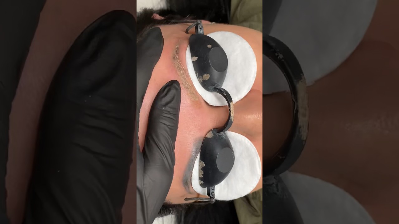 #laser #lasertattooremoval #lasertattooremovalspecialist #eyebrows #eyebrowslaserremoval #sprancene
