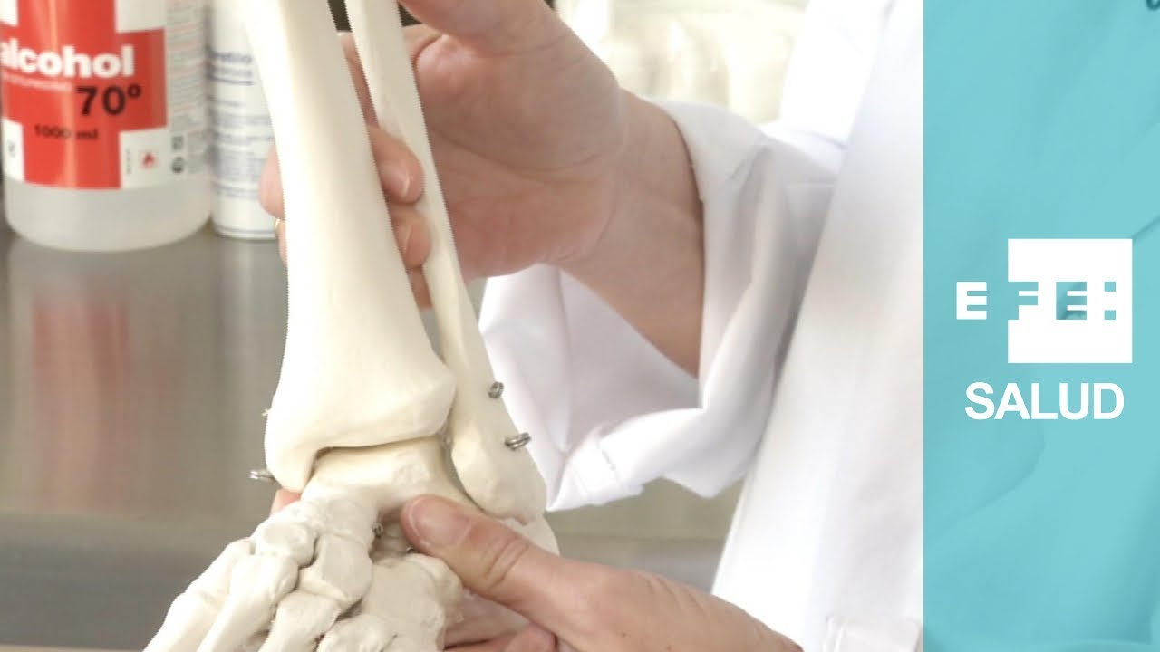 ¿Cómo se soluciona una fractura de peroné?