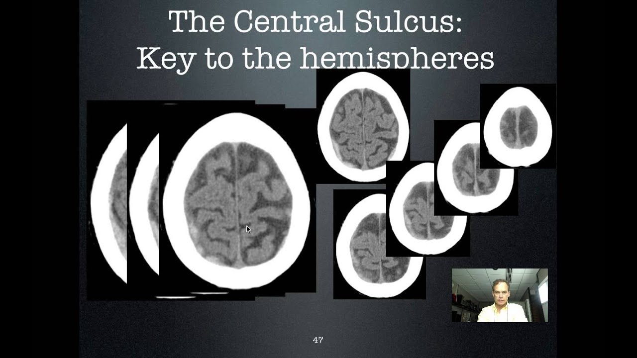 Central Sulcus: Key to the hemispheres