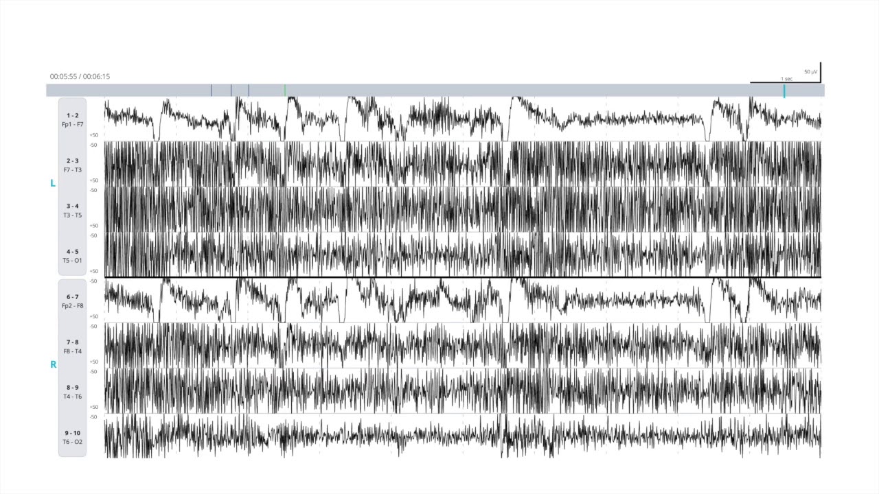 EEG Atlas B1: Recognize Common Artifacts Seen on EEG Using The Ceribell Rapid Response System